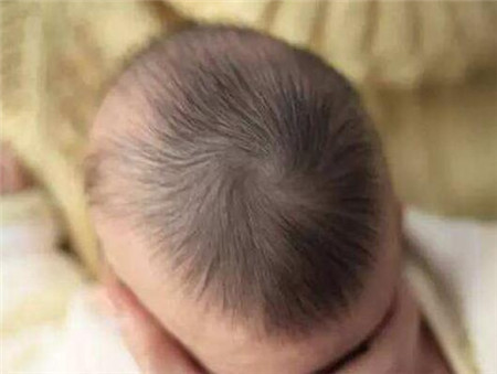 婴儿头上乳痂怎么去掉