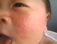 新生儿湿疹和痱子的区别