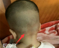 囟门什么时候闭合