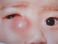新生儿泪囊炎的症状