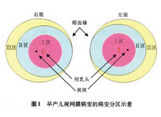 早产儿视网膜病变筛查指南