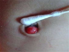 脐肉芽肿是怎么形成的2