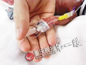 重庆一新生儿650克重脑袋如鹅蛋 成功存活 (图)