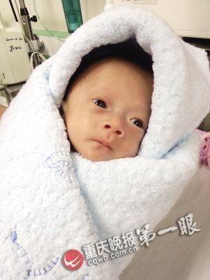 重庆一新生儿650克重脑袋如鹅蛋 成功存活 (图)