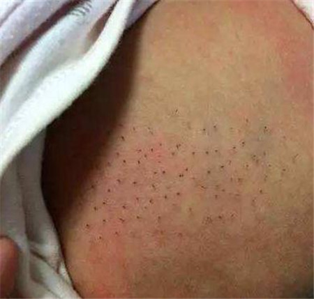 新生儿猪毛风是什么