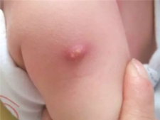 卡介苗化脓后如何处理2