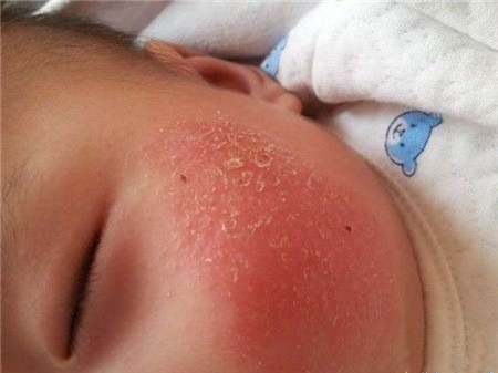 新生儿湿疹能自愈吗2