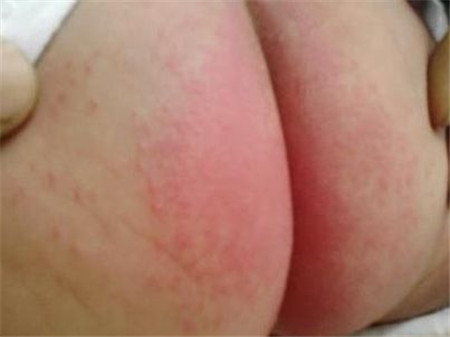 尿布疹还能用尿不湿吗2