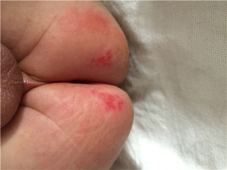 宝宝尿布疹可以擦红霉素软膏吗2