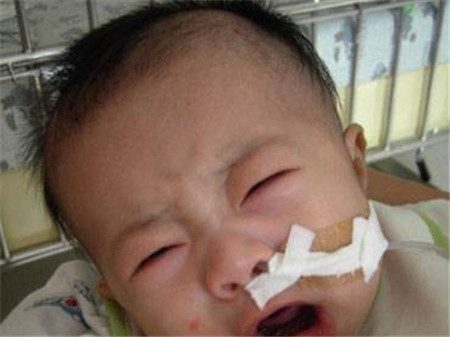 新生儿吸入性肺炎严重吗2