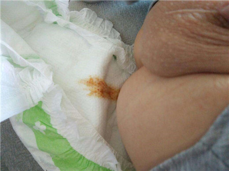 新生儿拉肚子能用丁桂儿脐贴吗2