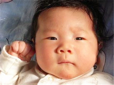 母乳性黄疸和病理性黄疸的区别3