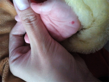 新生儿血管瘤怎么消除2