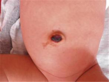 新生儿脐带什么时候掉5