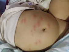 新生儿肚子起红点是怎么回事3