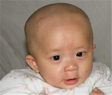 新生儿鲜红斑痣怎么办3