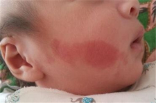 新生儿鲜红斑痣会自行消退吗3