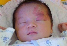 新生儿鲜红斑痣症状4