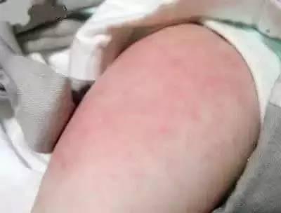 新生儿肚子起红点怎么回事 解决方法是什么2