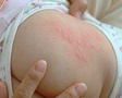 新生儿肚子起红点怎么回事 解决方法是什么3
