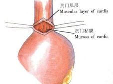 新生儿胃穿孔是怎么回事3