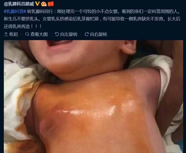 新生宝宝必须挤乳头？看看这都挤成什么样了！