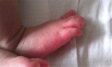 新生儿秋季脚上长水泡1