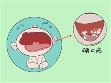 鹅口疮最佳治疗方法4