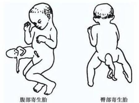 寄生胎是什么意思1
