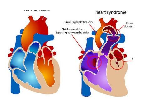 小儿心衰是怎么引起的1