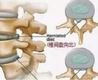 腰间盘突出最佳治疗6