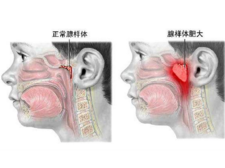 小儿腺样体肥大1