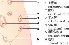 小儿疝气是怎么引起的
