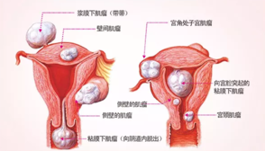 孕晚期子宫肌瘤对母体和胎儿的影响 妊娠合并子宫肌瘤处理方法