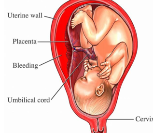 胎盘早剥的常见病因是什么 胎盘早剥可以保胎吗