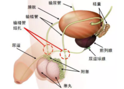 男性结扎有什么副作用 男性结扎影响性生活吗