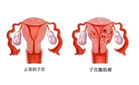 子宫腺肌症会导致不孕吗 子宫腺肌症是什么引起的