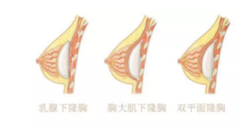 乳房整形手术对哺乳有影响吗 做过隆胸手术能给宝宝母乳吗