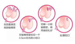 男性结扎后可以射精吗 男性结扎后精子会堵住吗