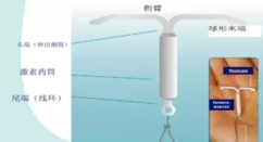 上曼月乐环不会痛经吗 上曼月乐环会缓解痛经吗