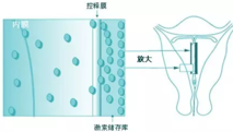 曼月乐环能够治疗哪些疾病 曼月乐环的作用与功效