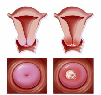 感染了HPV病毒多久会发展为宫颈癌 宫颈癌初期症状