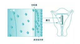 上曼月乐环不来月经正常吗 上曼月乐环月经量减少有影响吗