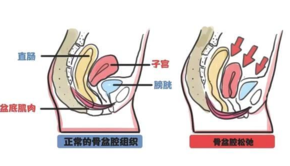 孕妇咳嗽漏尿怎么回事 孕妇咳嗽漏尿的原因