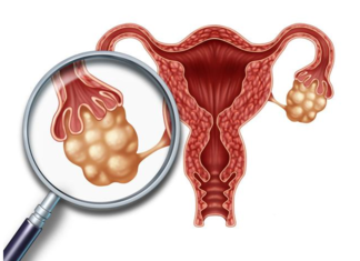 多囊卵巢有什么特点 多囊卵巢怎么治疗