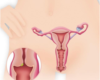 宫颈糜烂会得癌吗 什么情况下宫颈糜烂要重视起来