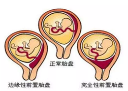 怀孕胎盘前壁后壁有什么区别 前壁和后壁哪个更有利于分娩