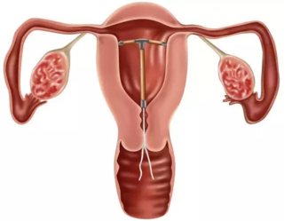 取环后迟迟不怀孕是怎么回事 取环后怎么快速怀孕