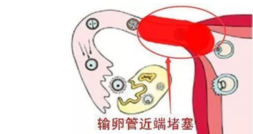 输卵管堵塞是吃药还是手术效果好 输卵管堵塞手术治疗方法