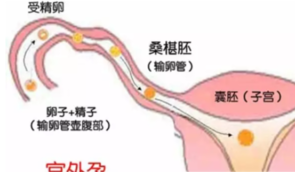 宫外孕有哪些症状 宫外孕怎么预防